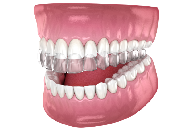治療後の歯並びをシミュレーション画像で確認